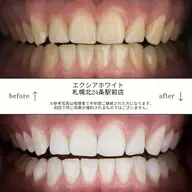 【定額⟡通い放題】🪞ᩚセルフホワイトニング ¥11,000/月