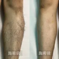 【メンズ脱毛】選べる！髭orうでor手の甲脱毛　¥3,000