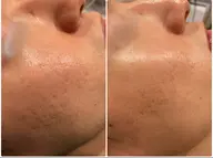 第4世代ピーリング【ララピール】✖️【アクアダーマ　ニキビケア】集中ニキビケア💎