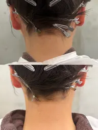 【うなじ脱毛】美容師しかできない襟足デザインカット➕光脱毛⭐️SHR搭載機種🪄最短4ヶ月で理想のうなじに🎀