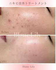 【ニキビケアトリートメント】★アクネピーリング