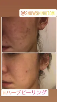 【3月限定★】肌生成ピーリング★古い角質を除去し、厚くなった角質を薄くし、肌再生を促します♪ 30分　ニキビ