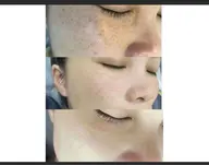 きれいなお肌オススメ・ピコレザーフェイシャル