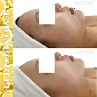 3月ご来店の方限定🍋クリニックレベルの脂肪コントロール✨️痛み・ダウンタイムなし!‼️【頬・フェイスライン】