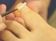 【オープン記念】辛い足に🦶痛くない🌸切らない🌸巻き爪矯正‼️プレート1枚⭐️初回限定