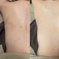 背中ニキビケア！夏までに背中美人☀️背中ハーブピーリング