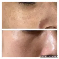 ハーブピーリング🌿ハーブリプロ🌿毛穴ケア・ニキビケア・しみシワたるみ改善◎トライアルセット🎁付き♪