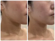 ✨新登場✨人気爆発フェイシャル🤩【ハイドロ✕Vリフト✕小顔ハンド】+【背中リンパマッサージ】のスペシャルメニュー