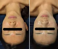 【毛穴・ニキビケア】reviハーブピーリング ✕ モデリングマスク