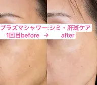 ❣️【モニター募集】地域唯一❣️【プラズマシャワー】美白・シミケア・ダウンタイムなし❣️