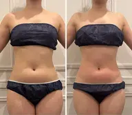 — Body Menu — 《くびれメイク》お腹周りの脂肪が気になる方にオススメ◎ ハイパーナイフEX✨