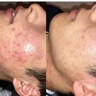 【ニキビケア】ニキビケア美容液導入+鎮静パックケア