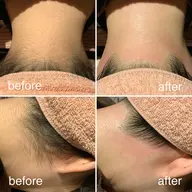 【WAX＋光脱毛】うなじ脱毛🧡スッキリうしろ姿も美人に✨