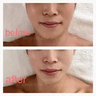 リフトアップフェイシャル