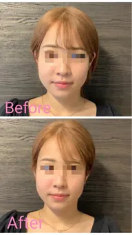 美容鍼トライアル