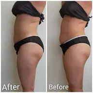 ミニモ限定🌟ハイパワー痩身お腹集中(60分コース)キャビテーション⇛ラジオ波⇛吸引+EMS⇛EXEMS