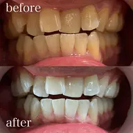 🦷🔰まずはお試し🔰🦷ナチュラルホワイトニング✨【通常¥9900→初回¥3600❤️‍🔥】今だけ価格！