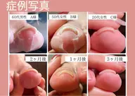 ヘイスイッチ【巻き爪ケア】