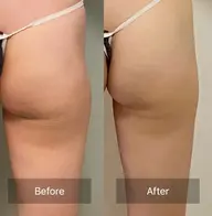 🍑まんまるヒップ🍑小尻・美尻ケア 30分