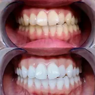 🌈一番人気🌈【🔥圧倒的効果！🔥】通常の6倍照射！【1日2名様まで】セルフホワイトニング🤍イベント前にも👗