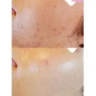 話題の乳酸ピーリング💄