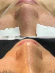 ハイドロスプラッシュ毛穴洗浄✨