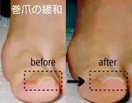 巻爪緩和・巻爪修正で痛み軽減⭕医療機関導入の矯正施術