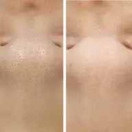 毛穴改善コース✨