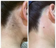 XXX WAXスキンケア脱毛 うなじ (メンズ+¥2200)