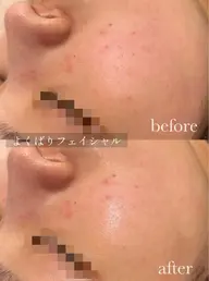 毛穴洗浄＋国産ハーブピーリングのよくばりフェイシャル/お肌をどうにかしたい方、メニューに迷った方はまずコレ！