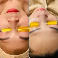 毛穴ケア　2回　6600円