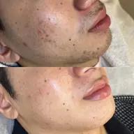 【メンズ/ヒゲ全体光脱毛¥2,000🧔🏽♂️】スキルアップレッスンモデル