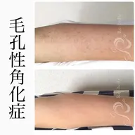 【二の腕ニキビ・毛孔性苔癬】二の腕ハーブピーリング🌿