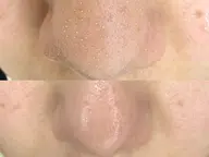 毛穴/黒ずみ/角質◎オーダーメイド毛穴洗浄3回券★通常→¥17,180