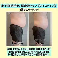 【写真モニター募集】皮下脂肪特化 超音波マシン《アイスナイフ》2部位