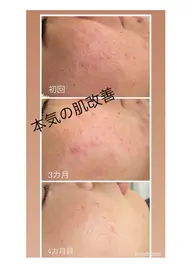 【吹き出物】【繰り返す肌荒れ】特化コース