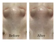 毛穴エクストラクション