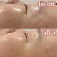 【エイジングケアピーリング】ラミネーションピール×ゾンビマスク