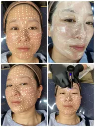 【メソスキンカラー】体験 毛穴洗浄+角質ケア16500円　※空き枠ない場合メッセージ下さい