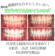 【超絶お得なプラン】Wプレミアムホワイトニング 4 来店計160分照射 徹底的な白さへ🦷✨