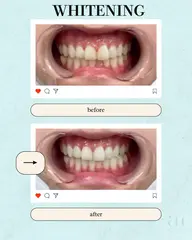⭐︎ホワイトニング⭐︎８分2セット⭐︎
