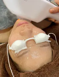 【全顔】毛穴の開きも改善・産毛がなくなることで化粧ノリも良くなる♪