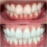 【歯の黄ばみに】ホワイトニング20分照射☆本当に白くなる♪と好評😄 まずはお試し✨