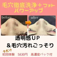 毛穴徹底洗浄+美肌光ケア❤️ハリ弾力潤いUPの美白肌へ✨通常13750円→8800円