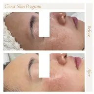 【顔脱毛×エステ】全顔1回