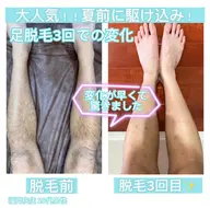 🔹メンズ脱毛🔹足を出す季節🏝️ プロによる脱毛で自己処理しない夏を過ごしませんか？　しっかり３回コース