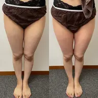 👣ご予約殺到👣しつこいお肉にトリプル攻撃🤛キャビテーション&ラジオ波&吸引　施術箇所：【太もも】