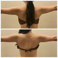 【初回】背中美人を目指して🩵スタイルアップの印象を💃背中&二の腕痩せ【最新痩身機器】