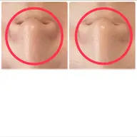 ハーブピーリング【毛穴、ニキビ】