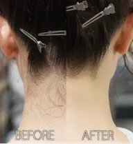 ツルスベうなじ脱毛